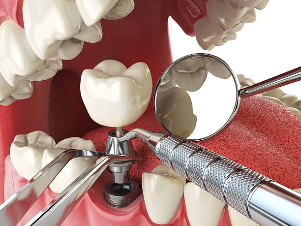 Best Emergency Wisdom Tooth Extraction in Stanleytown, VA
